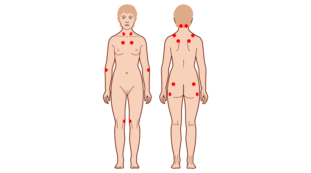 Fibromialgia Cdyte