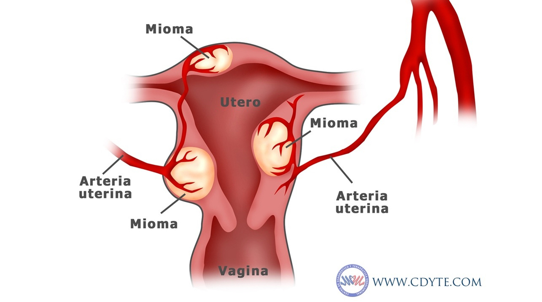 Cum să scapi de varice cu miom uterin