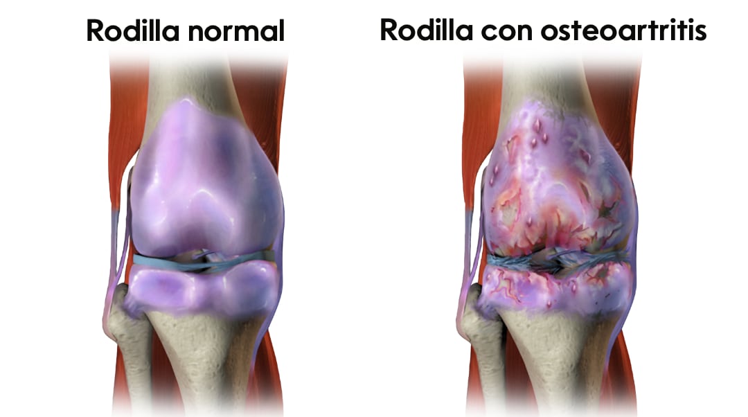 Osteoartritis
