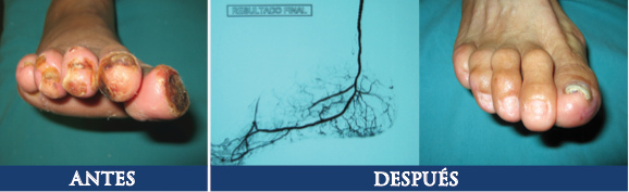 Isquemia crítica con revascularización endovascular.
