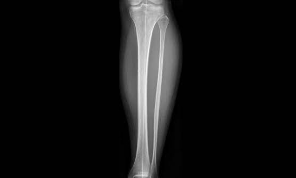 Radiografía de una tibia y peroné sano