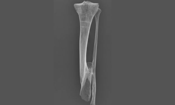 Radiografía de una tibia y peroné con sisdesmosis